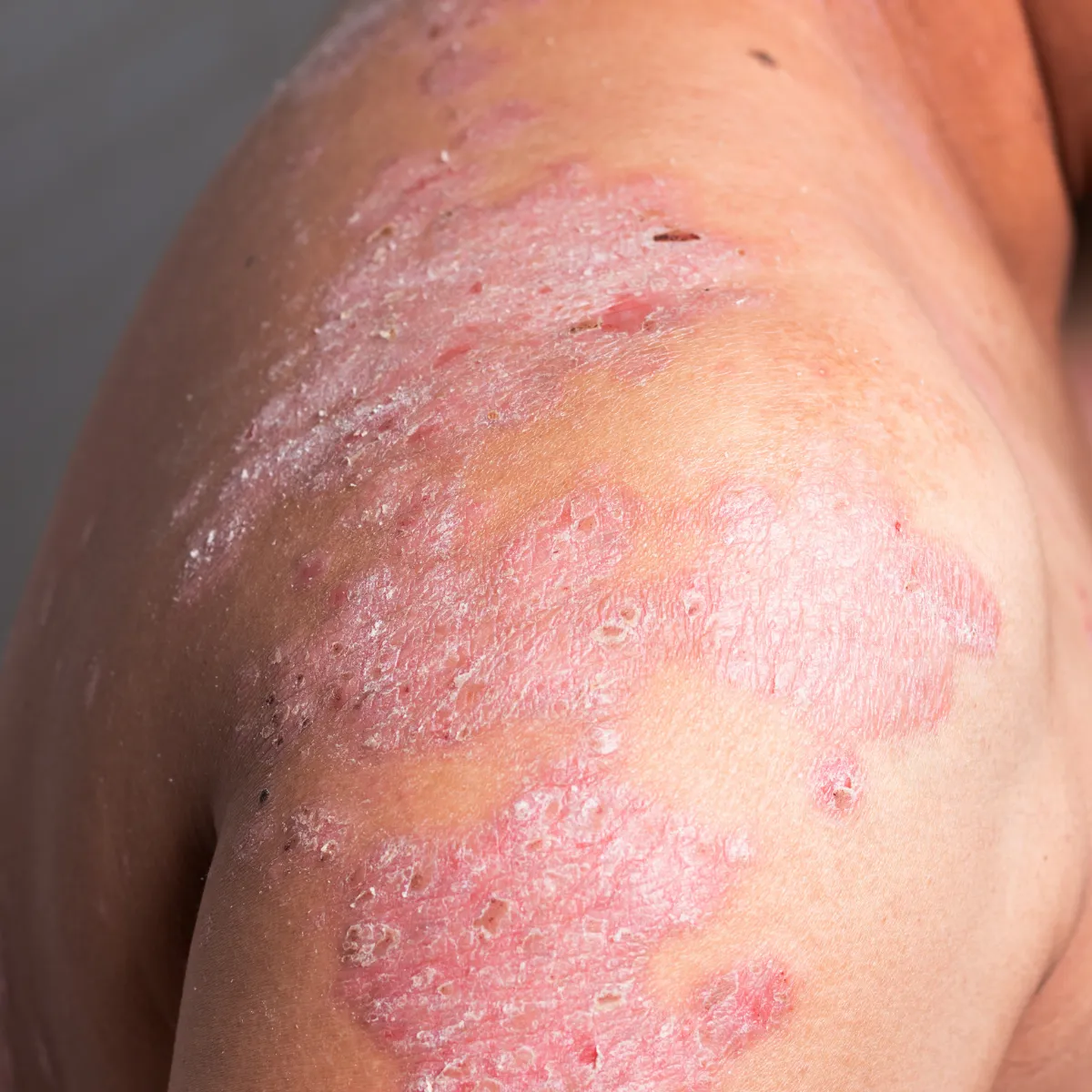 Homeopathic treatment for Psoriasis