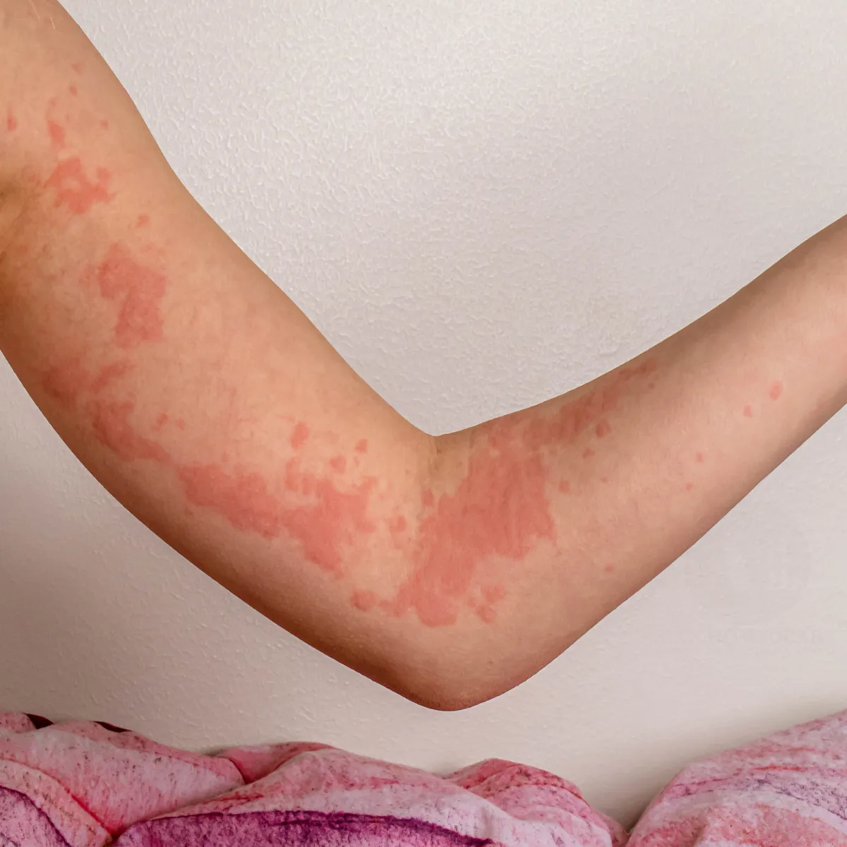 Homeopathic treatment for Urticaria and Hives